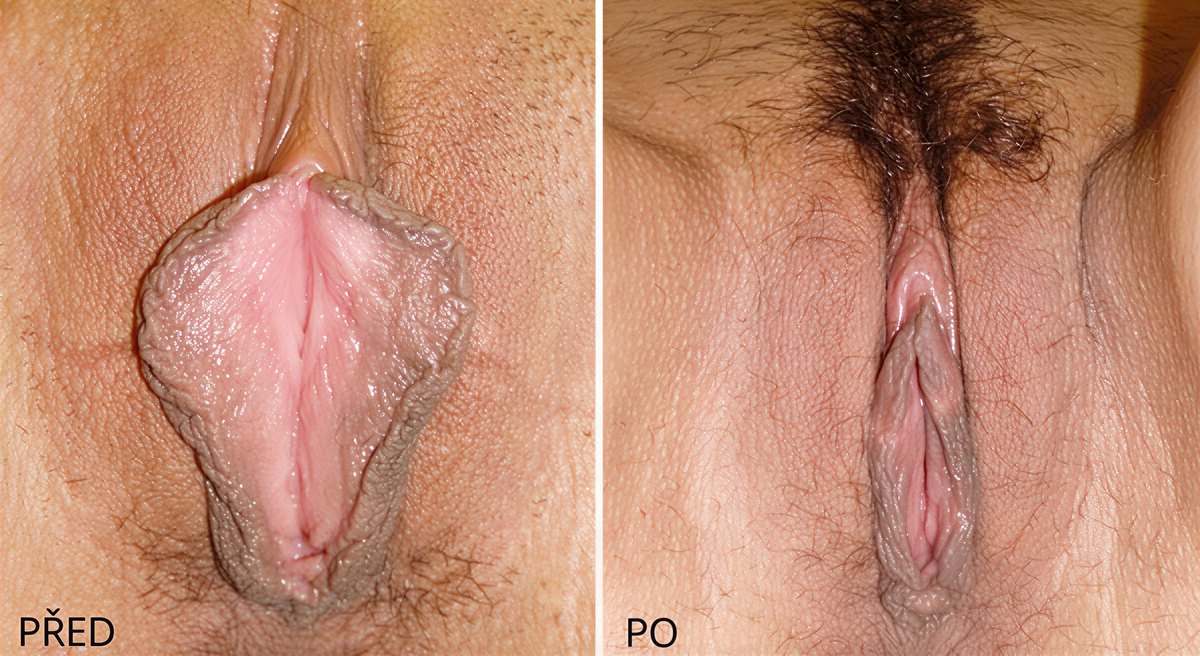 Resultados antes y después de labioplastia en ABClinic Art & Beauty, mejora del aspecto labial