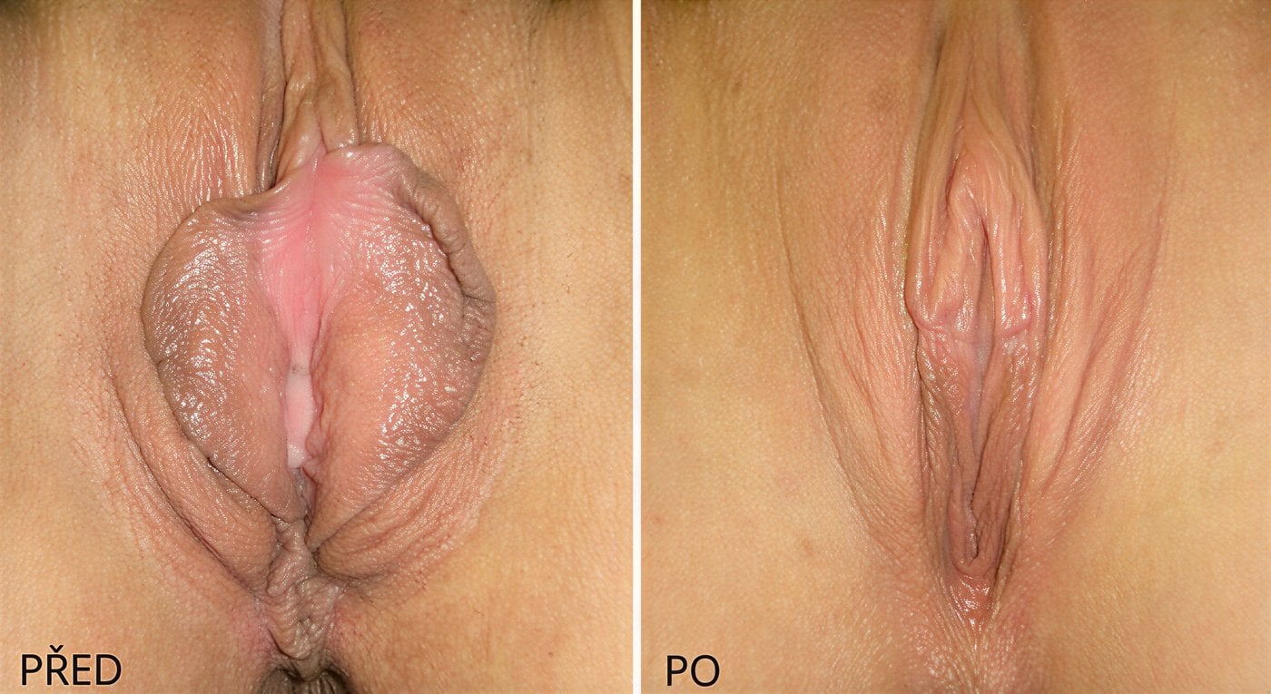 Resultados antes y después de labioplastia en ABClinic Art & Beauty, mejora de labios
