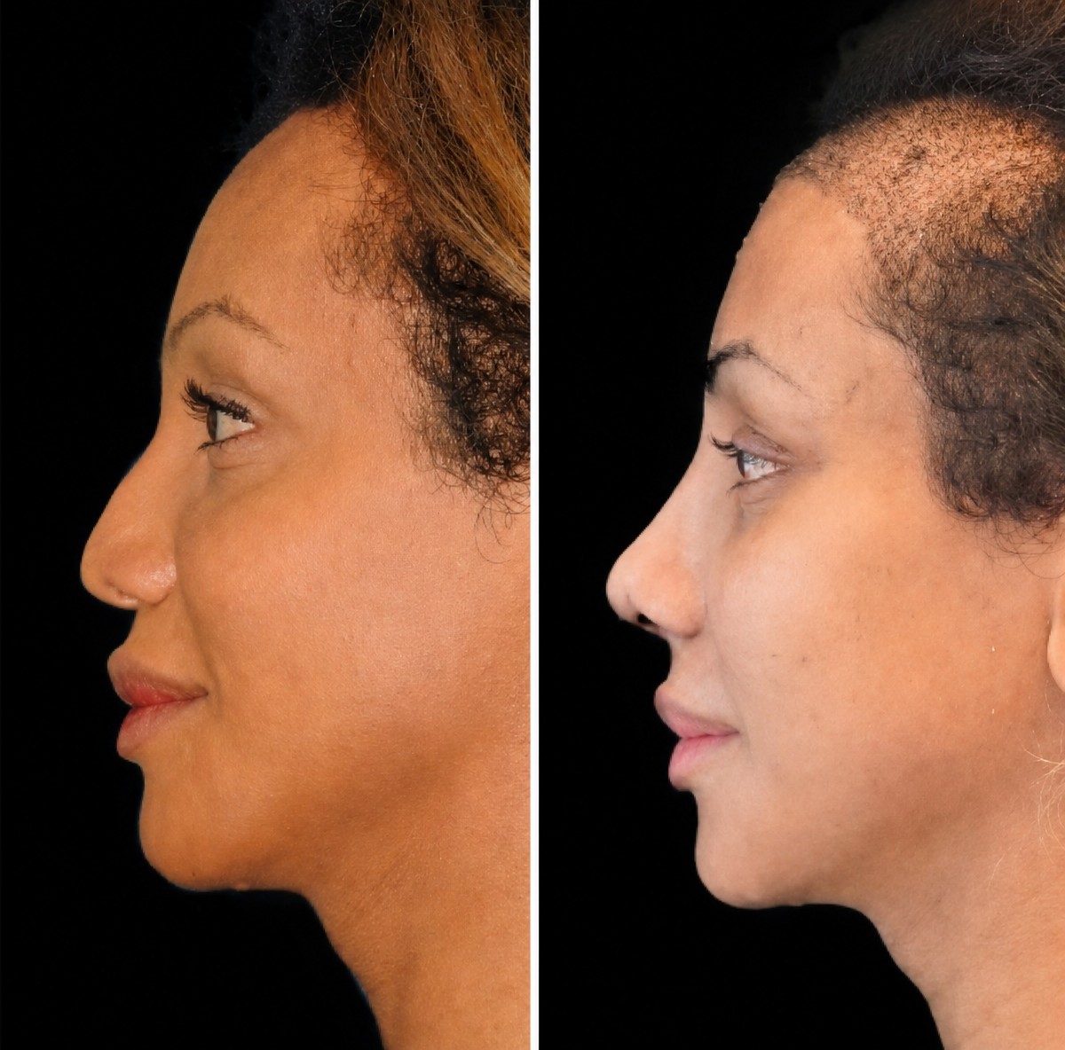 نتائج زراعة الشعر الأفريقي قبل وبعد في عيادة د. إيلكر مانافباشي، خط شعر محسّن