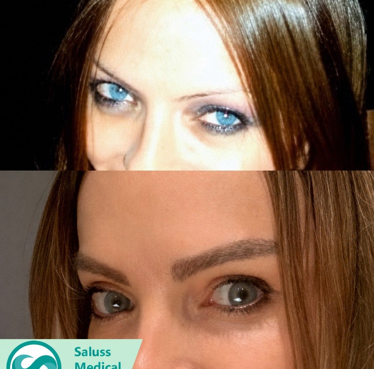 Resultados de trasplante de cejas antes y después en SALUSS Medical Group, restauración natural
