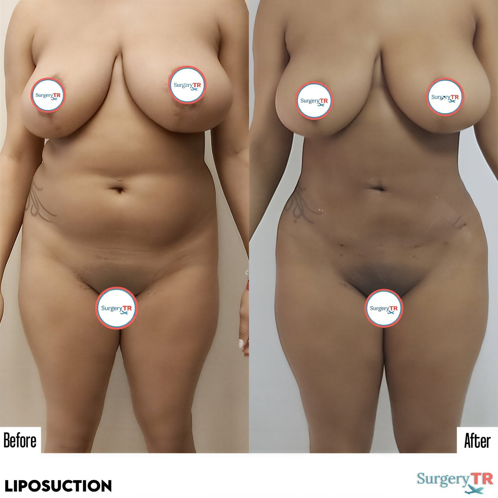نتائج شفط الدهون قبل وبعد في عيادة SurgeryTR، تحسين واضح لتناسق الجسم