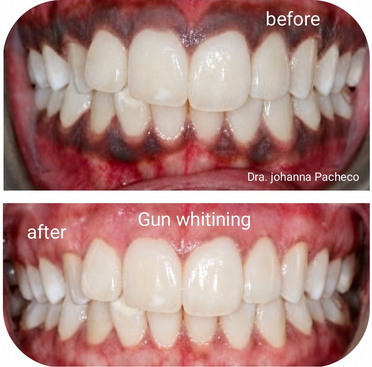 نتائج تبييض اللثة قبل وبعد في Love Dental and Sthetic Clinic، ابتسامة أكثر إشراقًا