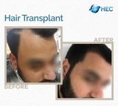 نتائج زراعة الشعر قبل وبعد في HEC Turkey، استعادة خط الشعر وكثافة الشعر