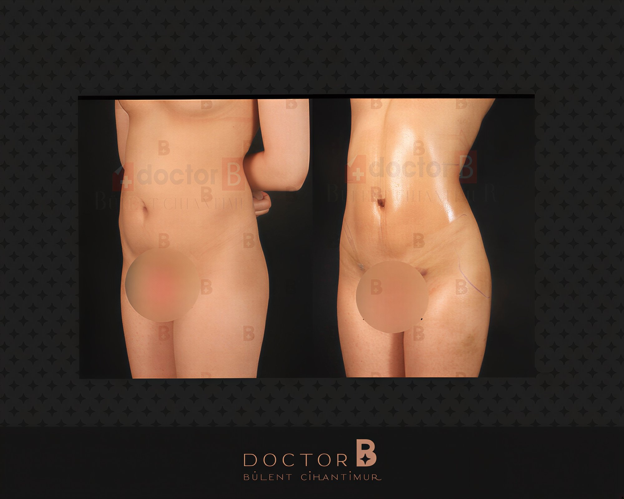 نتائج شد البطن والشفط قبل وبعد في Doctor B Clinic، تحسين شكل البطن