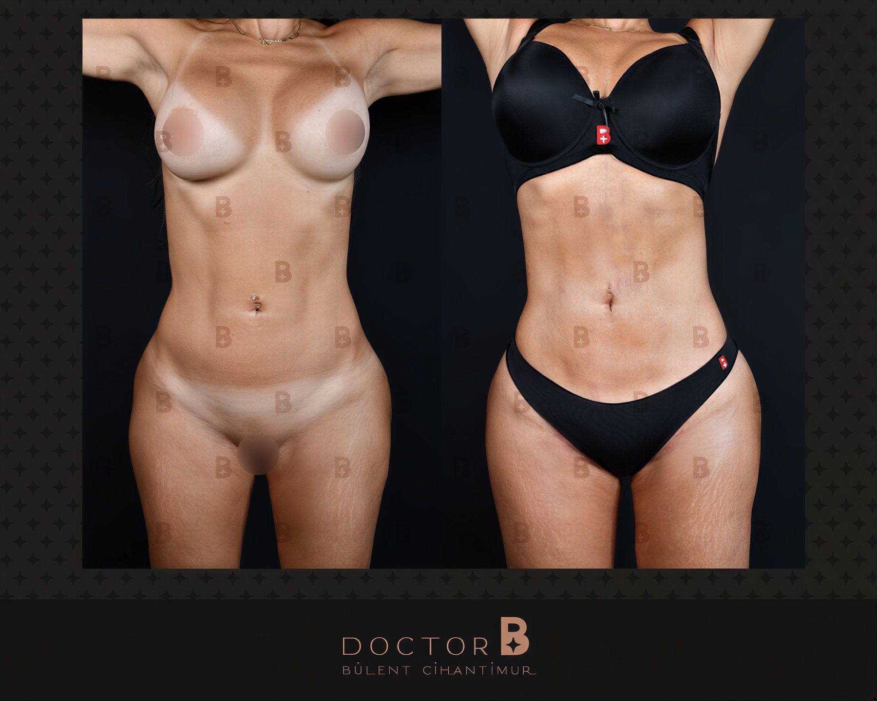 Resultados de abdominoplastia y liposucción antes y después en Doctor B Clinic, mejor contorno corporal