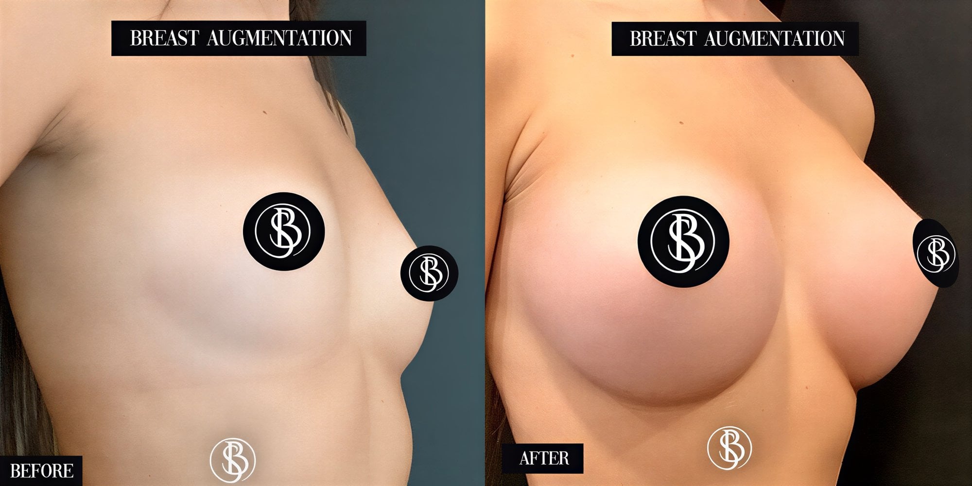 Antes y después de implantes y lifting de senos en Dr. Salih Onur Basat, senos más llenos