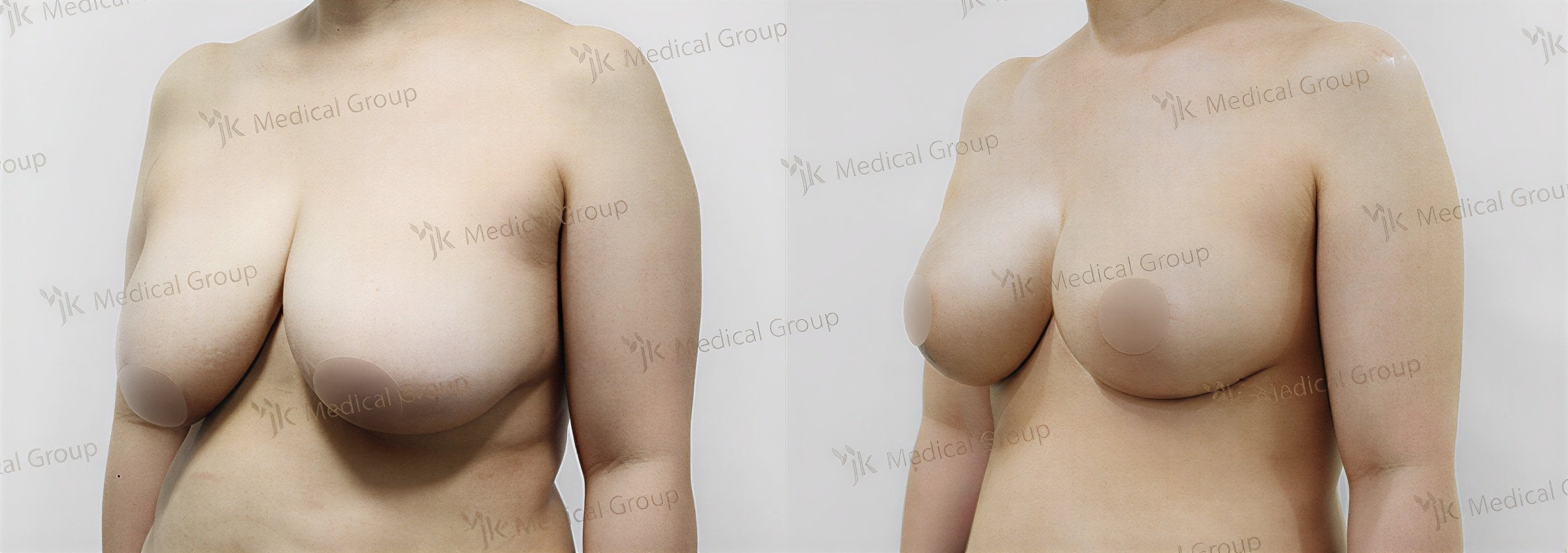 Resultados antes y después de reducción de senos en JK Plastic Surgery Center, mejor contorno