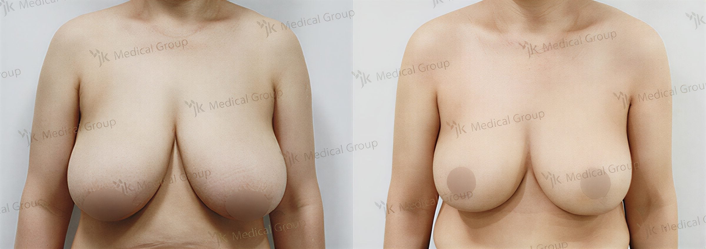 نتائج تصغير الثدي قبل وبعد في JK Plastic Surgery Center، تحسين شكل الثدي