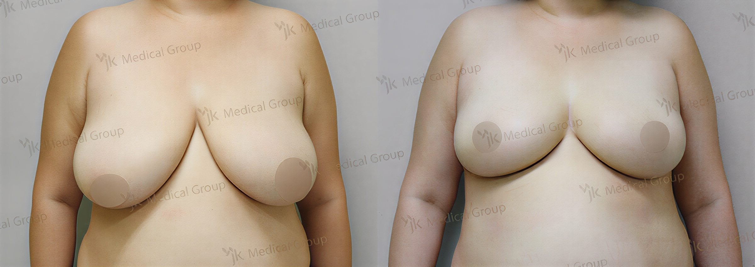 نتائج قبل وبعد تصغير الثدي في JK Plastic Surgery Center، تحسين شكل الثدي
