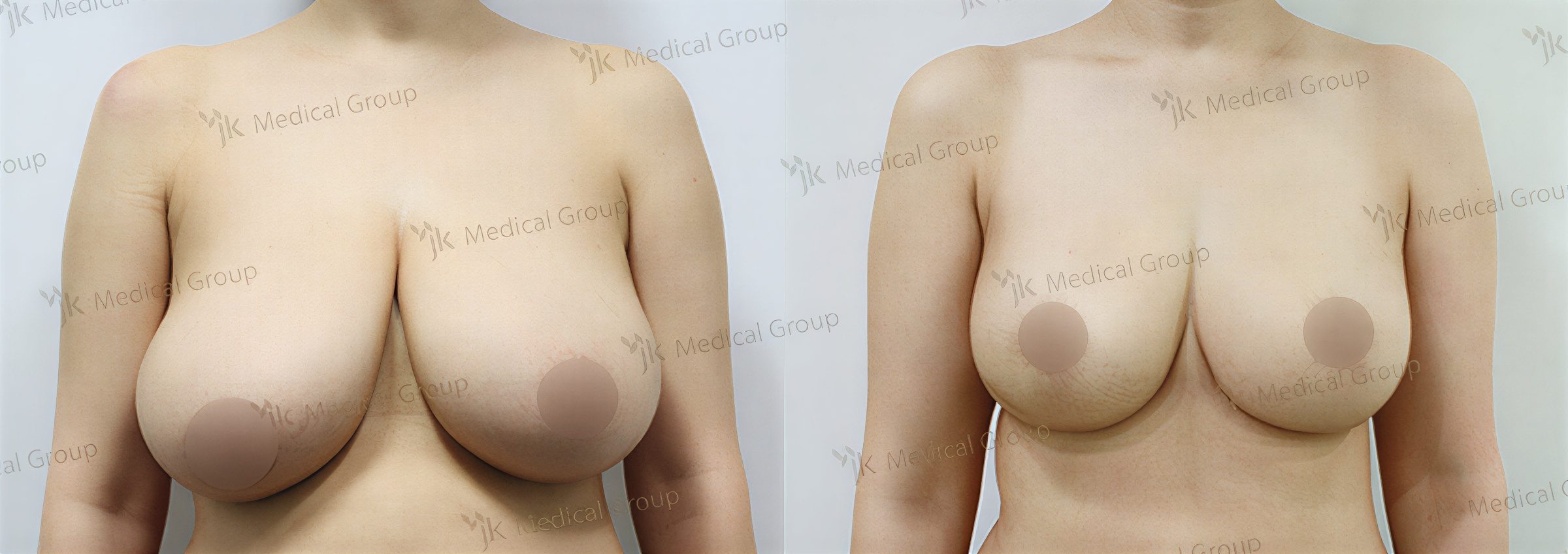 Resultados antes y después de reducción de senos en JK Plastic Surgery Center, mejor contorno