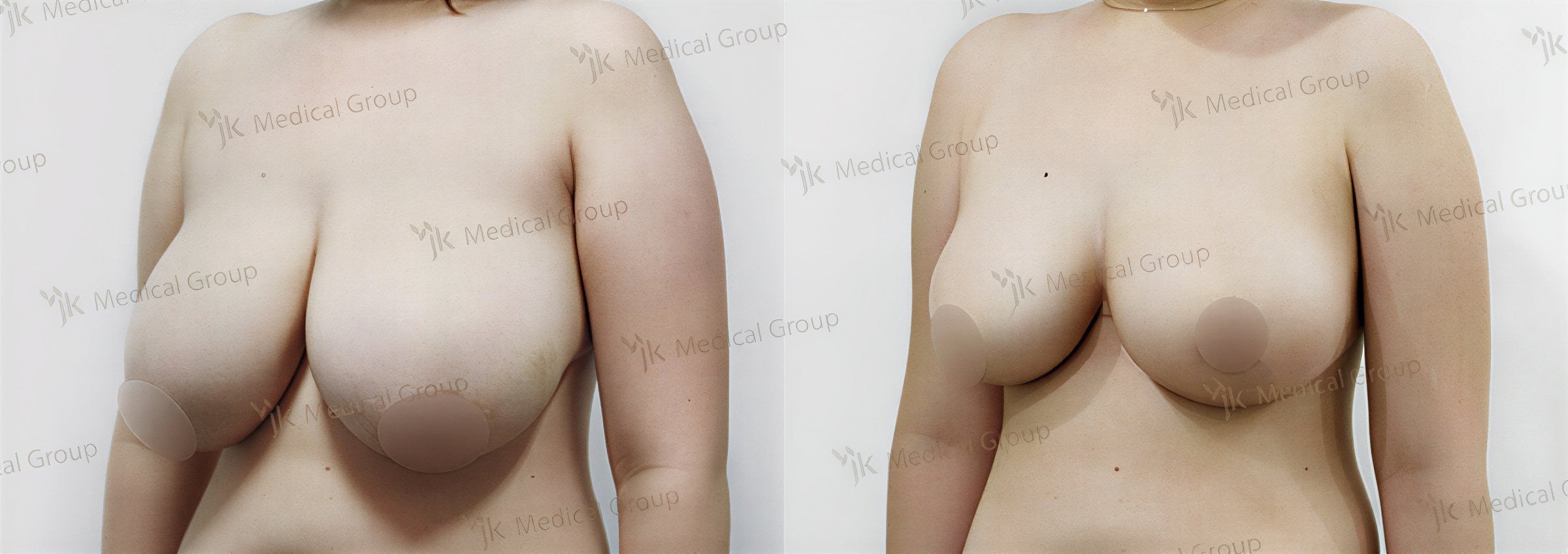 Resultados antes y después de reducción de senos en JK Plastic Surgery Center, mejor contorno