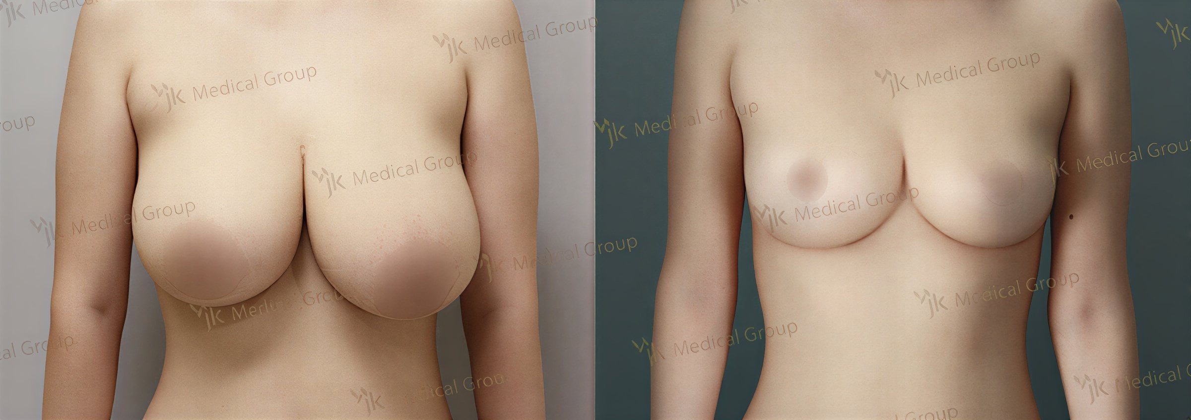 نتائج تصغير الثدي قبل وبعد في JK Plastic Surgery Center، تحسين شكل الثدي