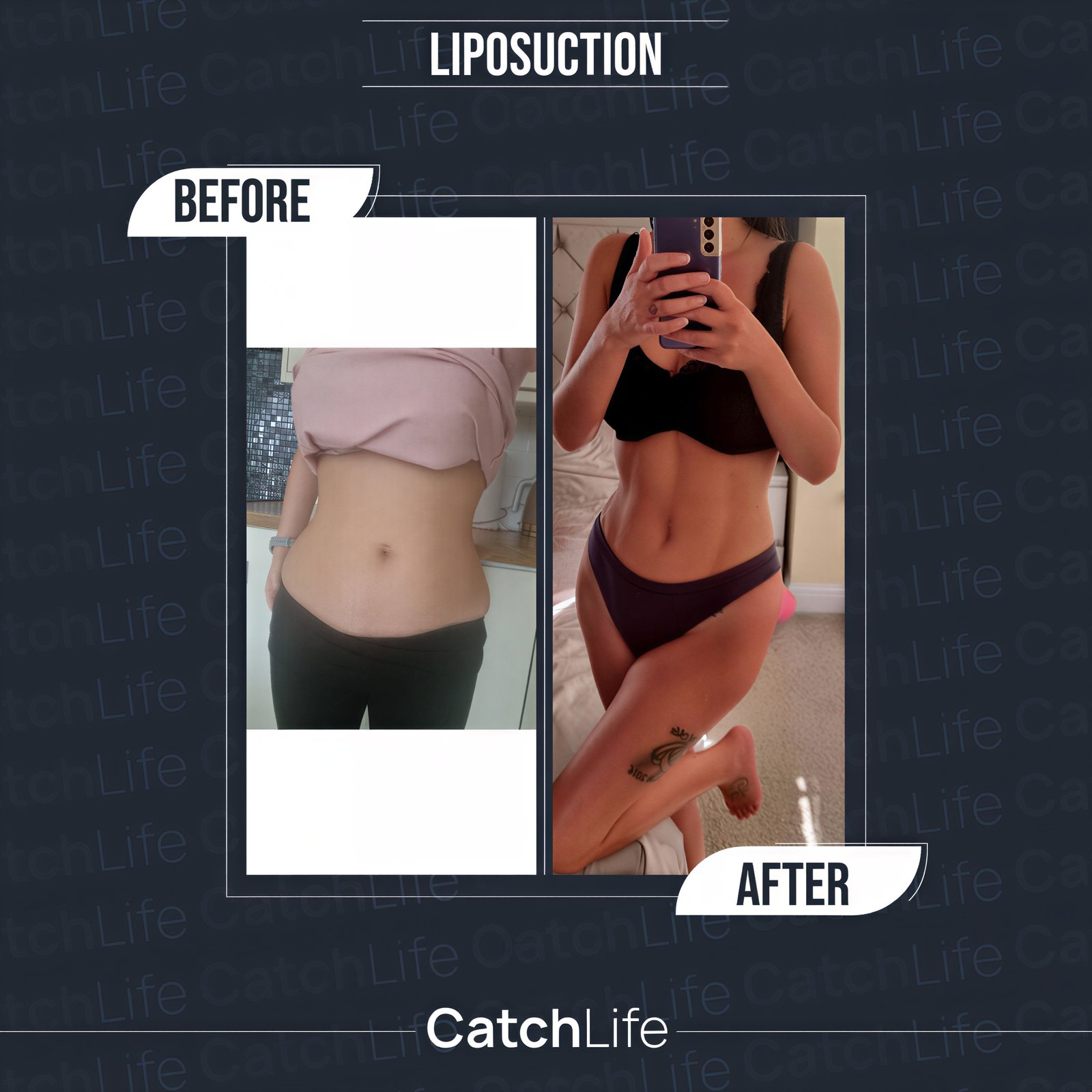 Resultados de liposucción antes y después en CatchLife, mejora visible del contorno corporal
