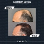 نتائج زراعة الشعر قبل وبعد في CatchLife – استعادة خط الشعر وكثافة أكبر