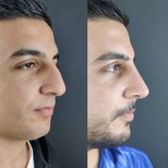 نتائج تجميل الأنف قبل وبعد في Health & Beauty Turkey Clinic، تحسين شكل الأنف