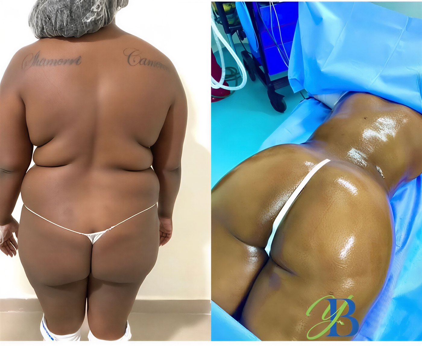 Resultados de liposucción antes y después en Centromedicovergel, mejora del contorno corporal