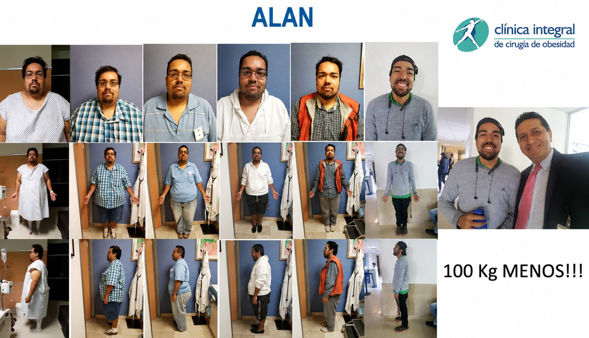 Resultados de manga gástrica antes y después en Clínica Integral de Cirugía de Obesidad, 100 kg menos