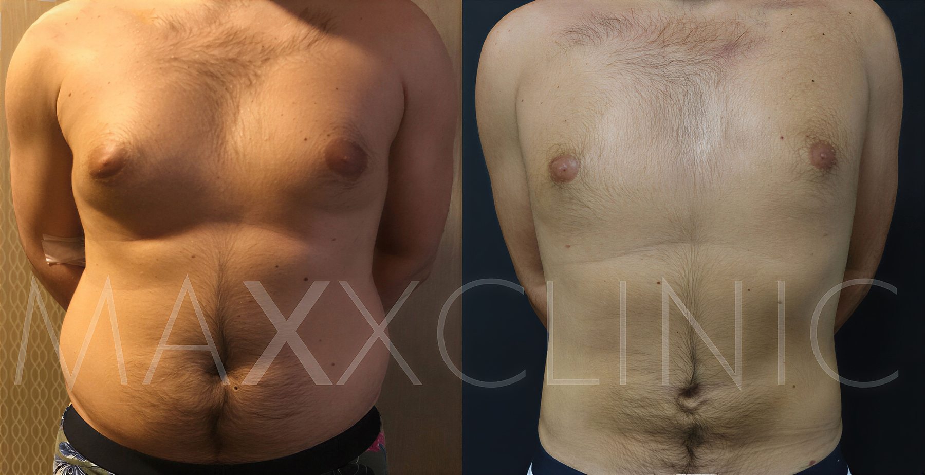 قبل وبعد شفط الدهون لعلاج التثدي في MaxxClinic، نتيجة نحت صدر الرجل