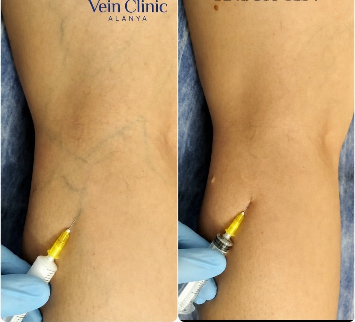 Antes y después de escleroterapia para varices en Vein Clinic Alanya, reducción visible de venas