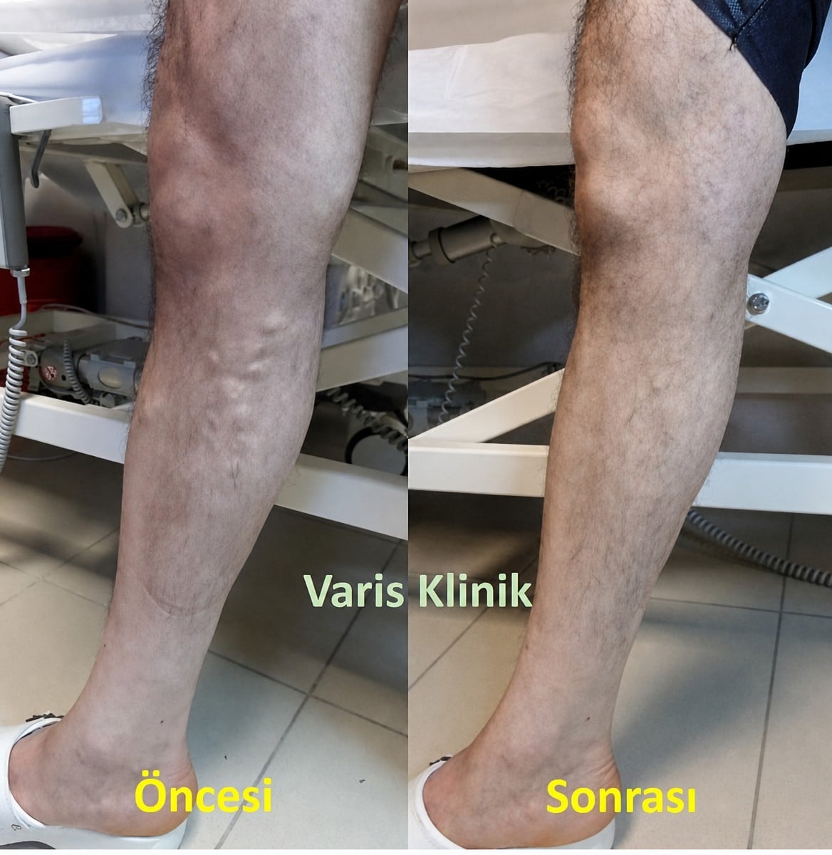 Antes y después de escleroterapia de varices en Vein Clinic Alanya, resultados visibles en pierna