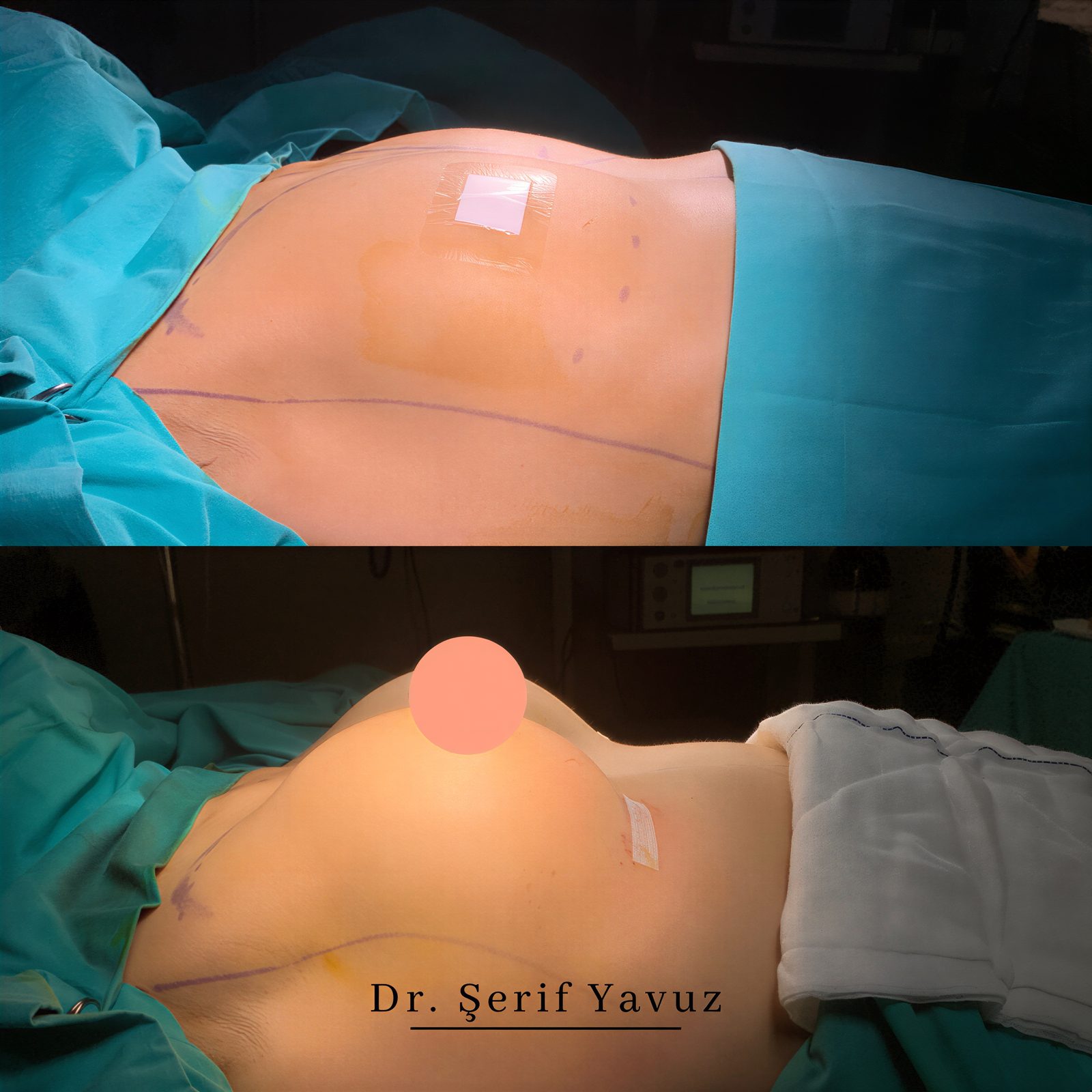 Resultados antes y después de aumento de senos en Op. Dr. Serif Yavuz's Private Practice