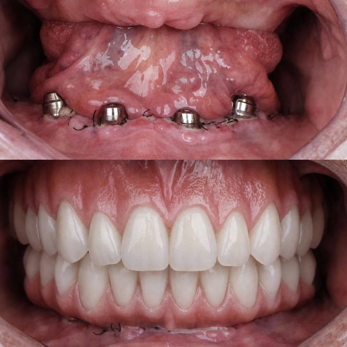 نتائج قبل وبعد زراعة الأسنان لهوليود سمايل في My Nova Kusadasi Dental Clinic