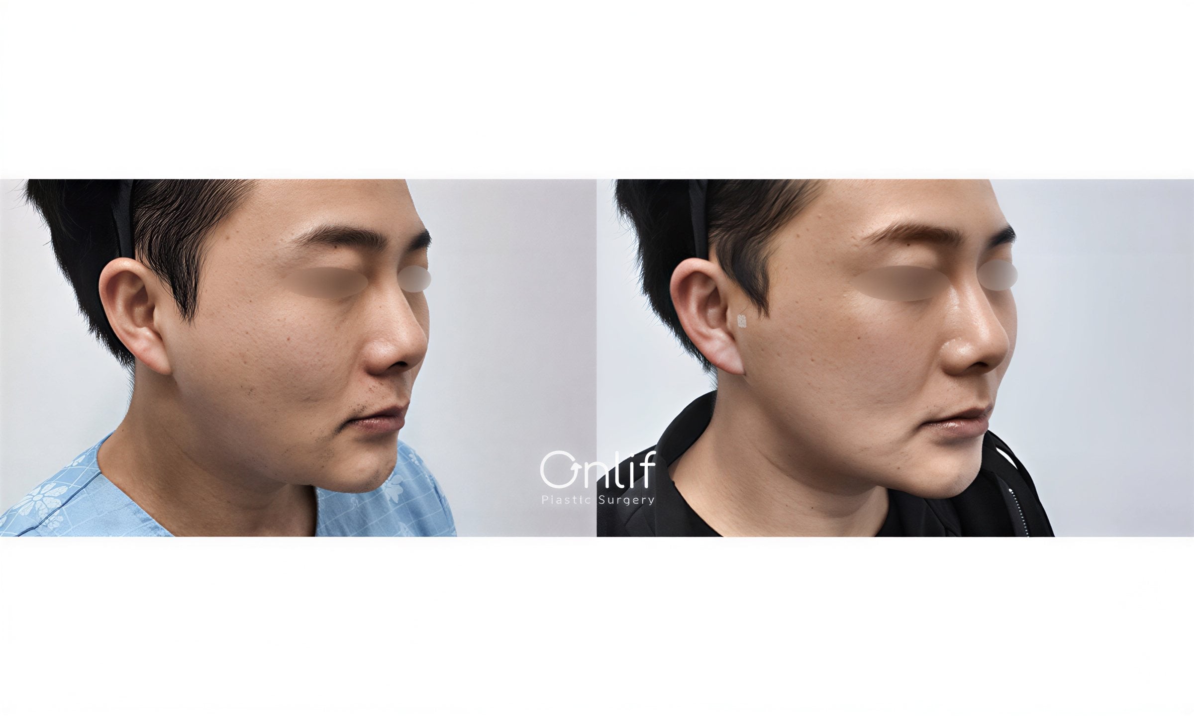 Resultados de liposucción antes y después en Onlif Plastic Surgery Korea, contorno facial mejorado