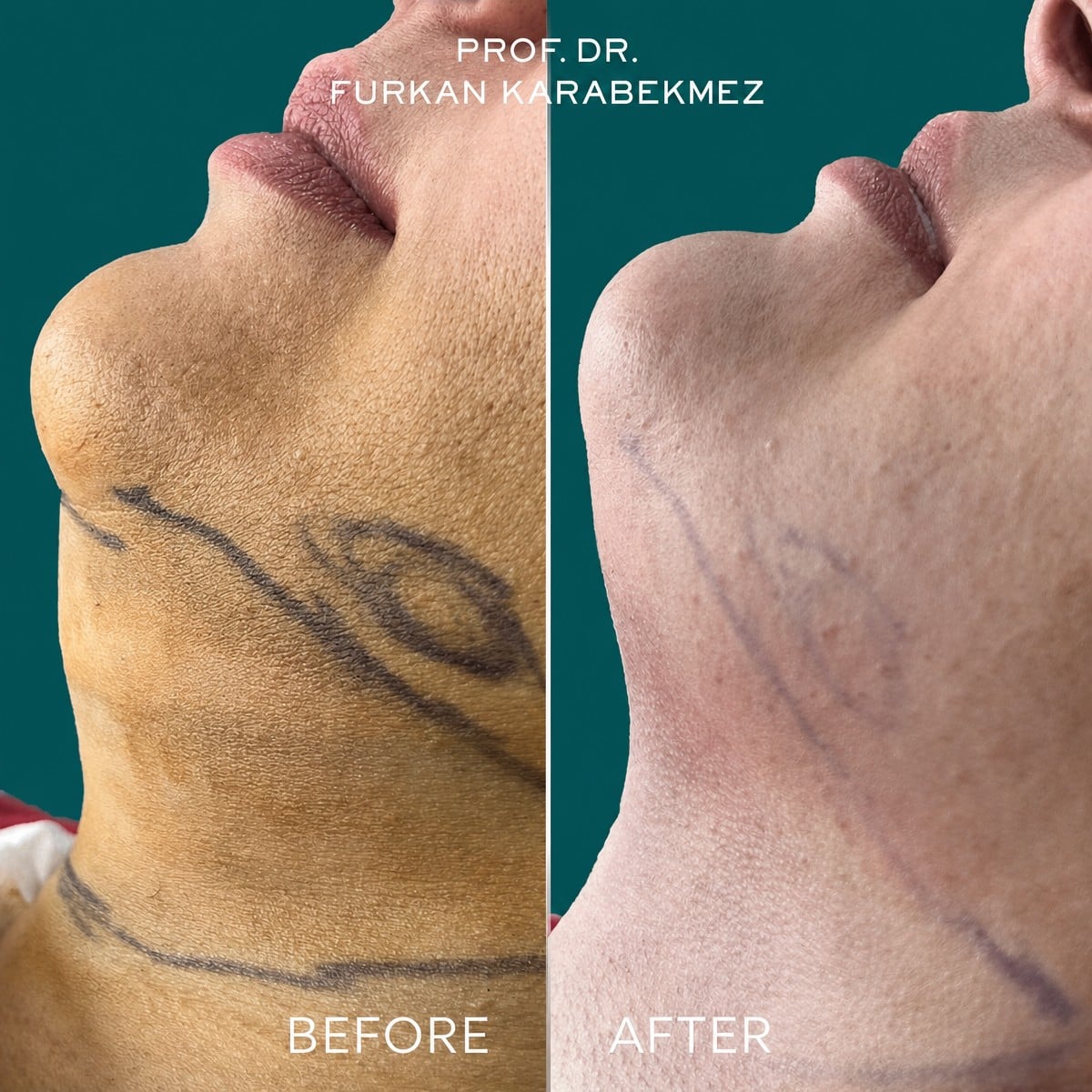 Resultados de liposucción de mentón antes y después en la clínica Prof. Furkan Karabekmez