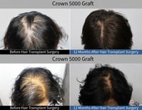 نتائج زراعة شعر التاج 5000 طعم قبل وبعد في عيادة MOAMAN لزراعة الشعر