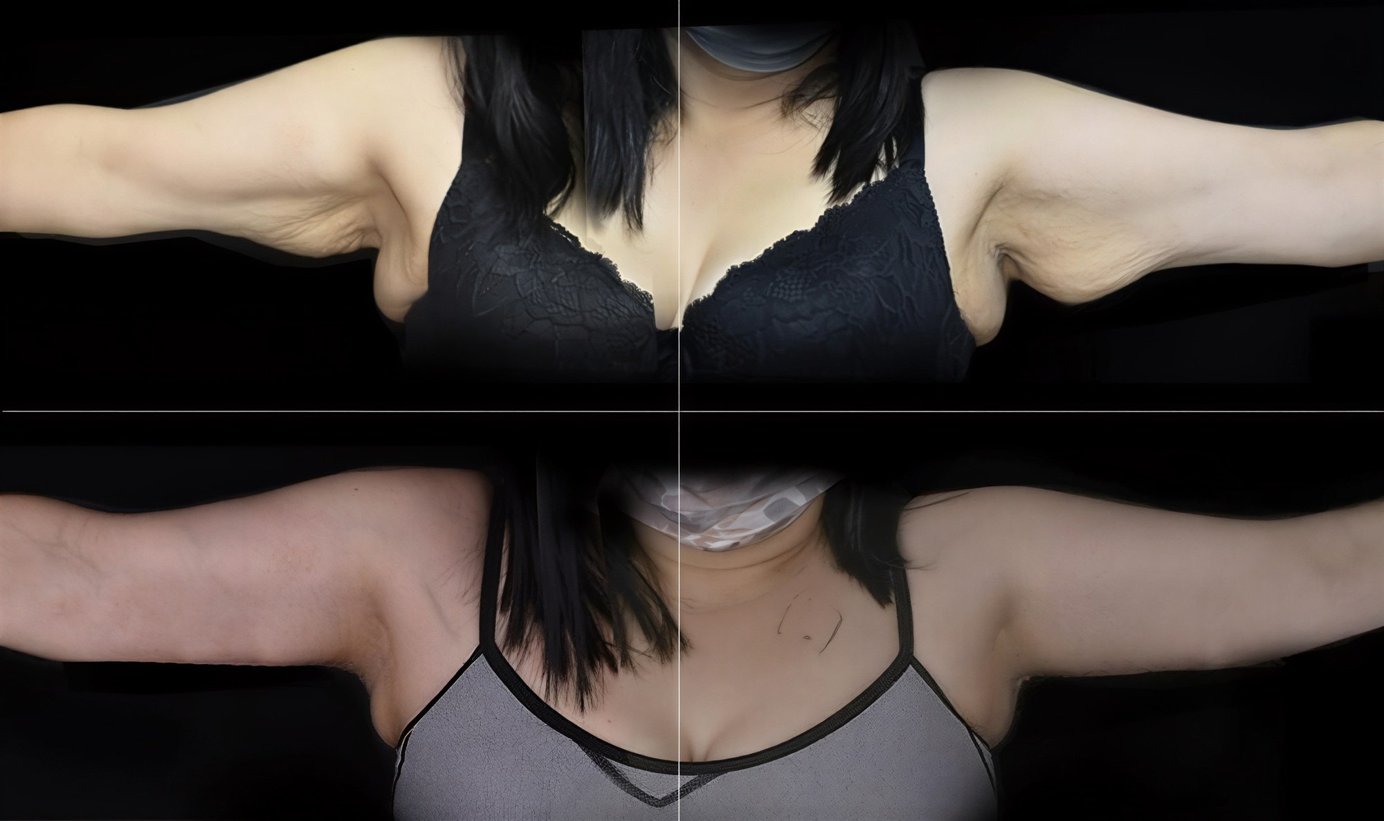 Resultados de liposucción de brazos antes y después en Happy Esthetic Clinic, contorno mejorado