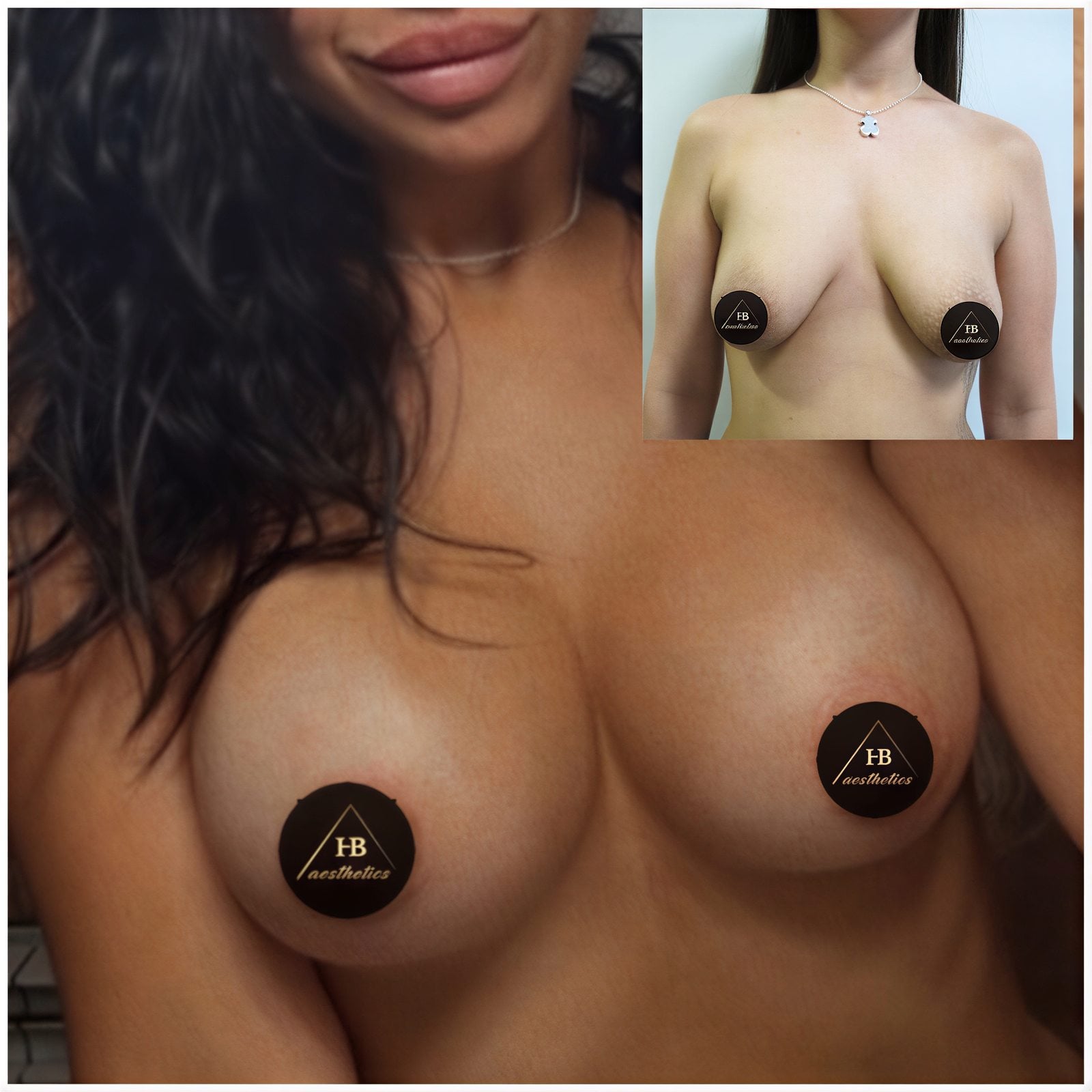 Resultados antes y después de mastopexia con implantes redondos en Dr. M. Hakan BULAM