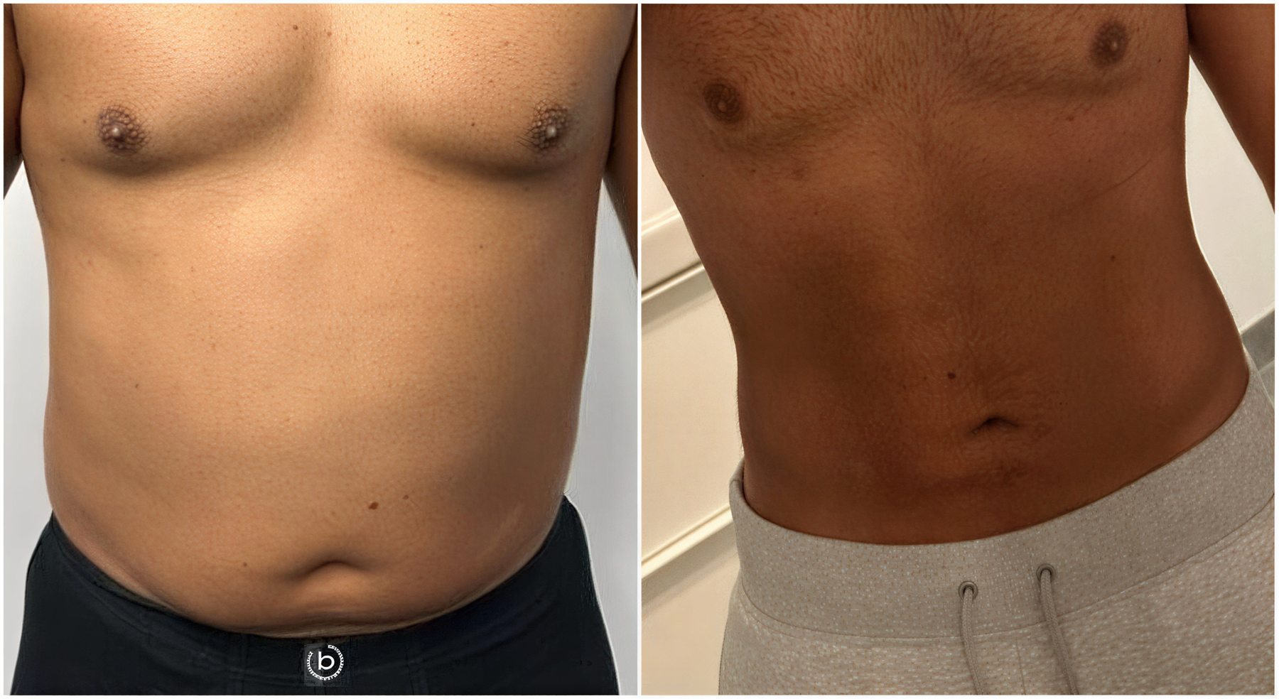 نتائج شفط الدهون قبل وبعد في عيادة د. هاكان بولام لجراحة التجميل