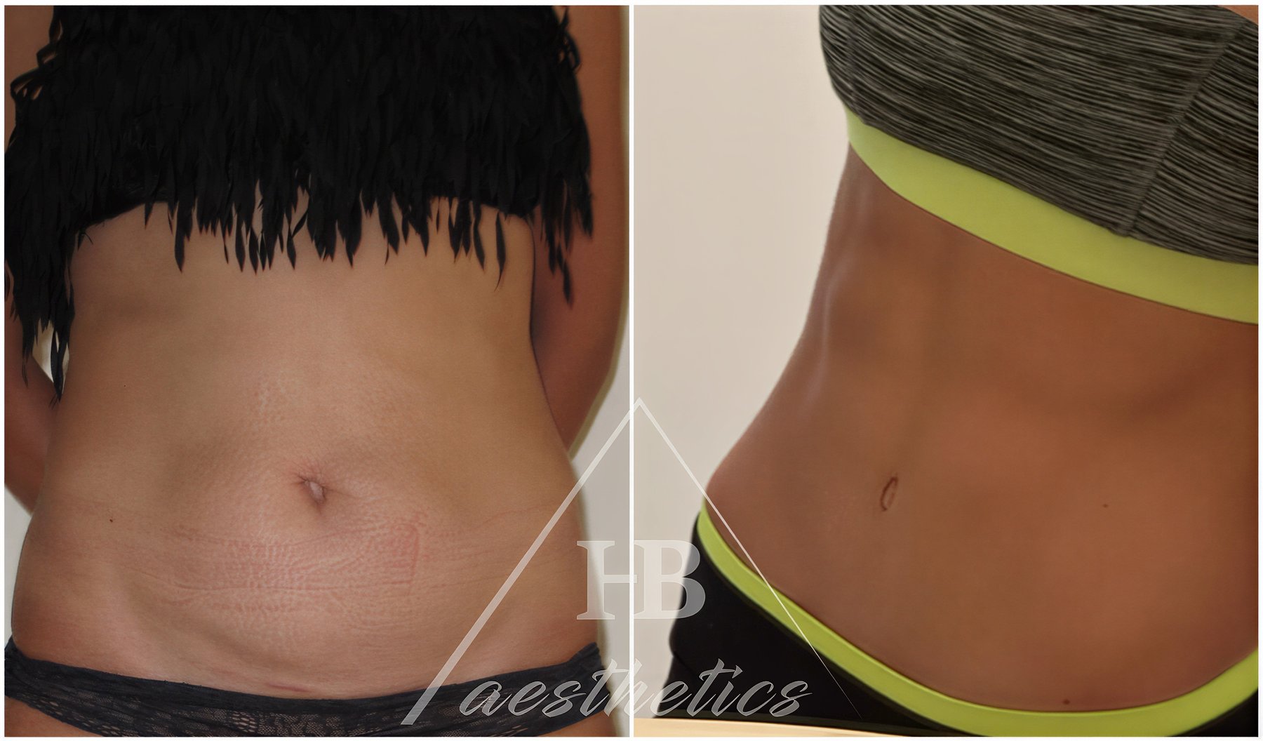 نتائج شفط الدهون قبل وبعد في عيادة Dr. M. Hakan BULAM Aesthetic Plastic Surgery