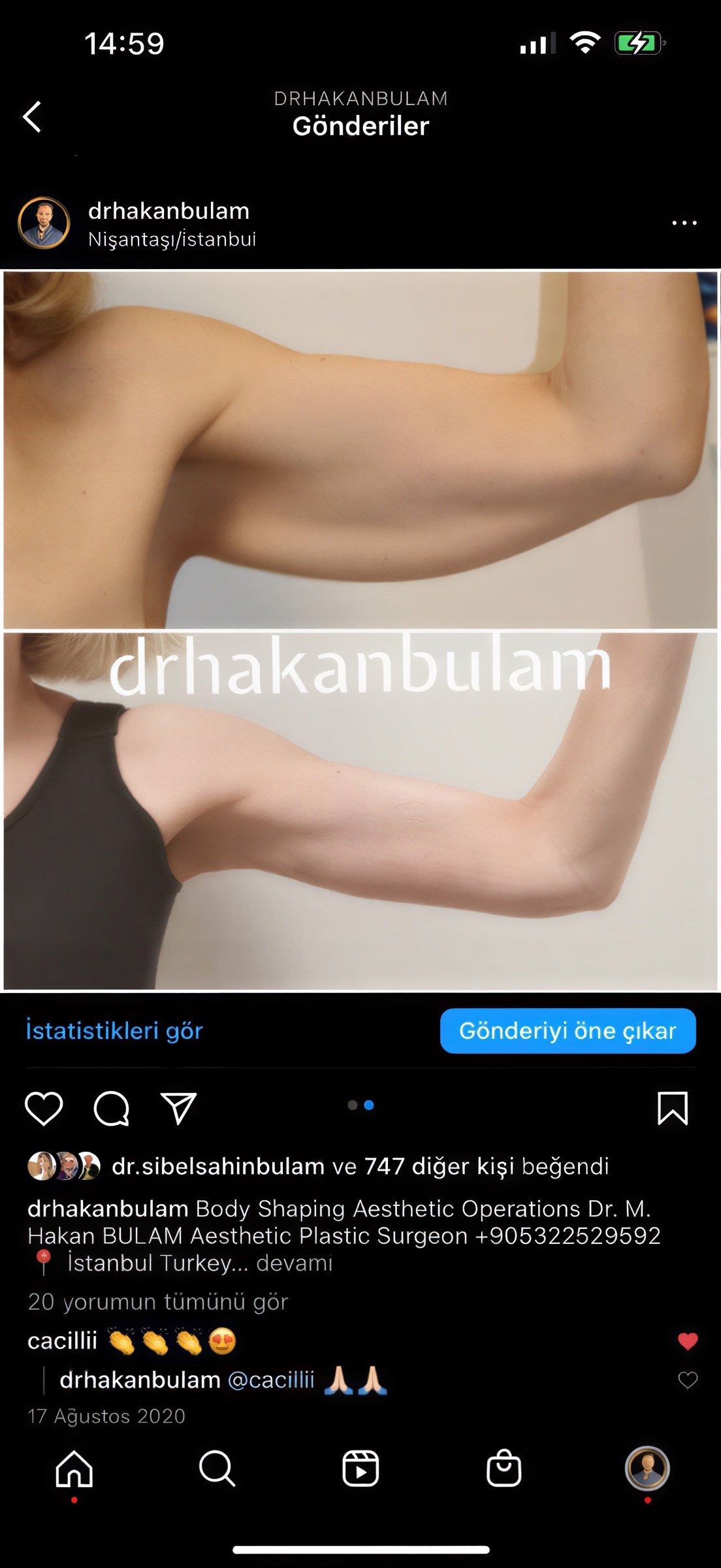 نتائج شفط دهون الذراعين قبل وبعد في عيادة د. هاكان بولام لجراحة التجميل