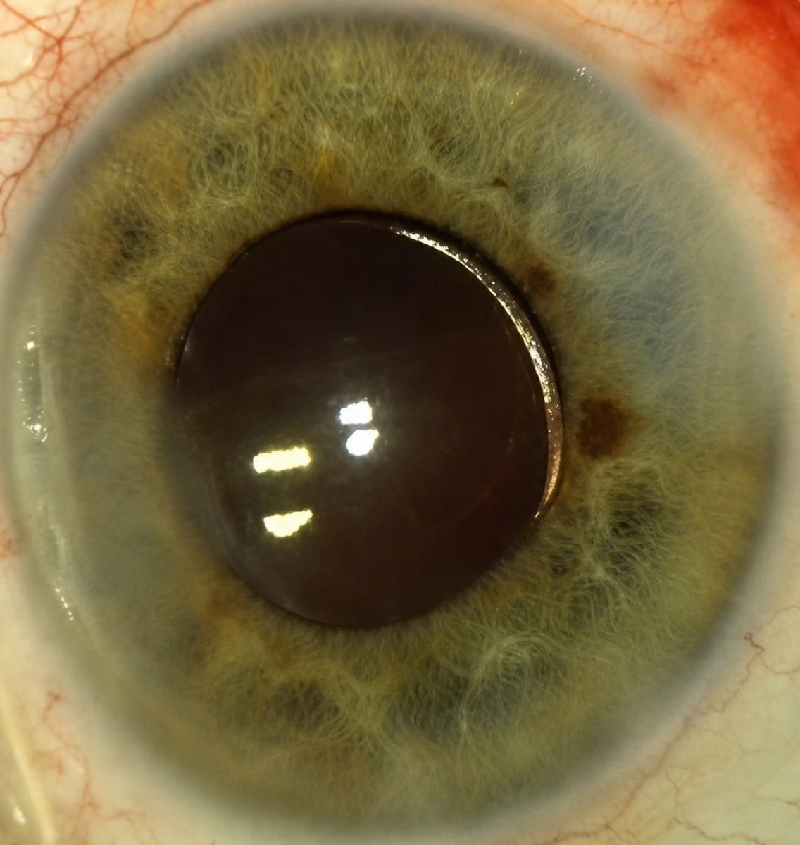 Resultado tras cirugía de cataratas en Dr Nikolaos I Dervenis MD, MSc, PhD, FEBO - lente clara
