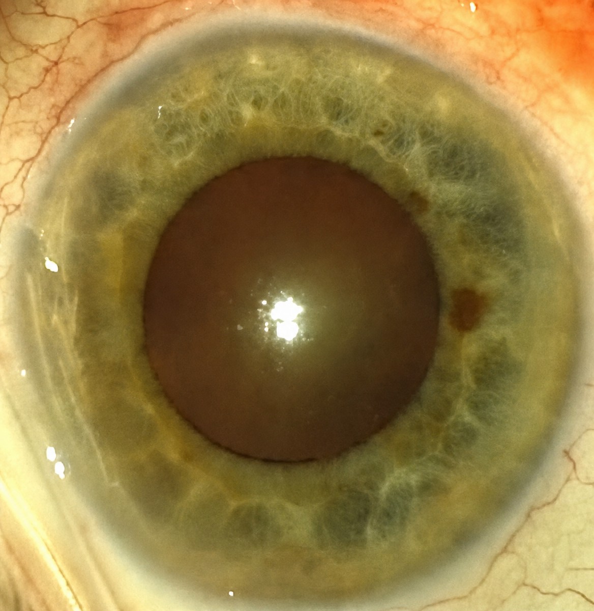 Resultado de cirugía de cataratas en Dr Nikolaos I Dervenis MD, MSc, PhD, FEBO – lente clara
