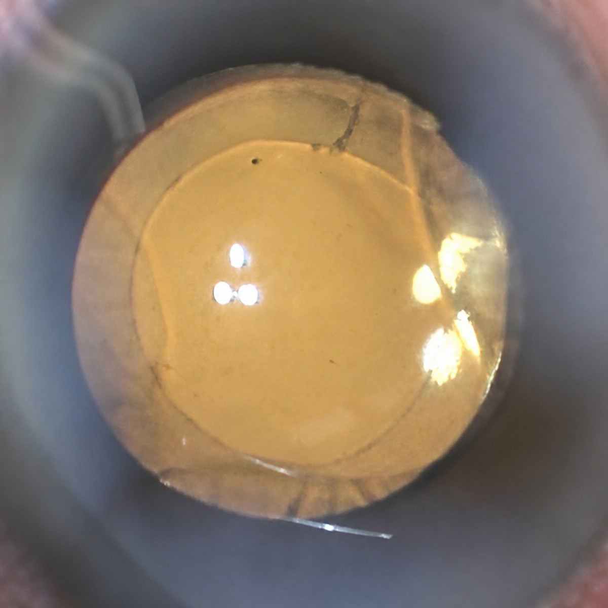 Resultado tras cirugía de cataratas con lente multifocal en la clínica Dr Nikolaos I Dervenis