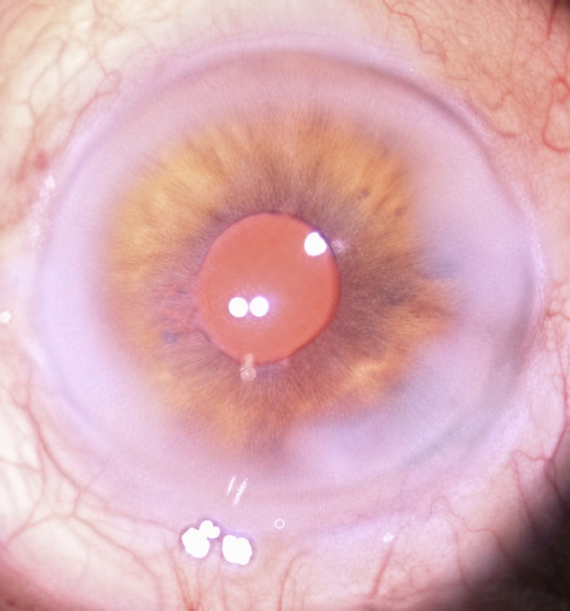 Resultado de cirugía de cataratas con reemplazo de LIO en Dr Nikolaos I Dervenis MD, MSc, PhD, FEBO