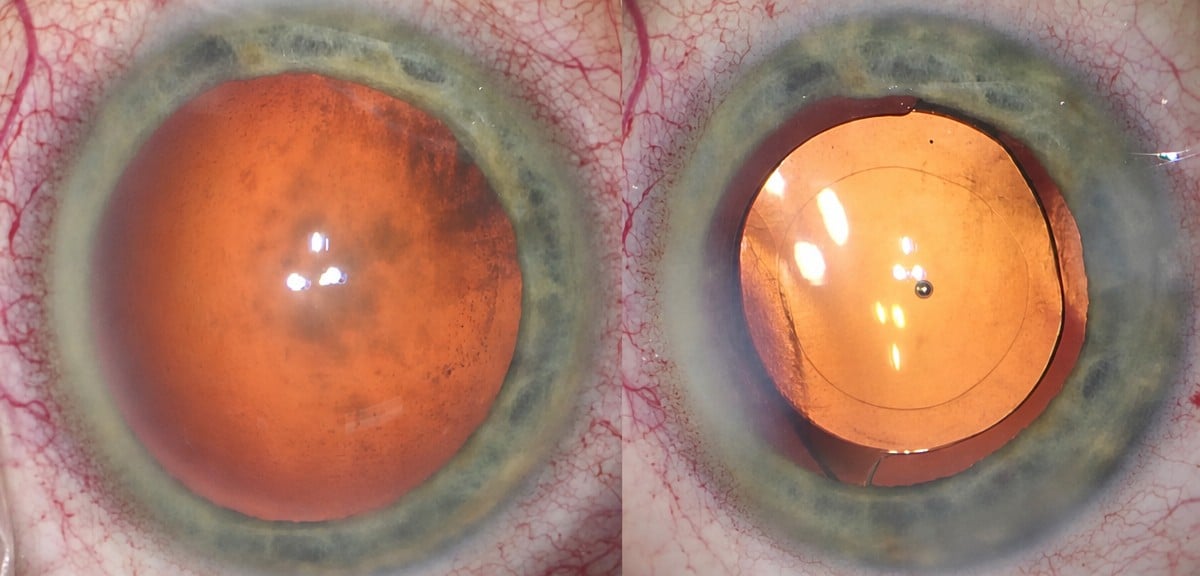 Resultado antes y después de cirugía de cataratas con LIO en Dr Nikolaos I Dervenis
