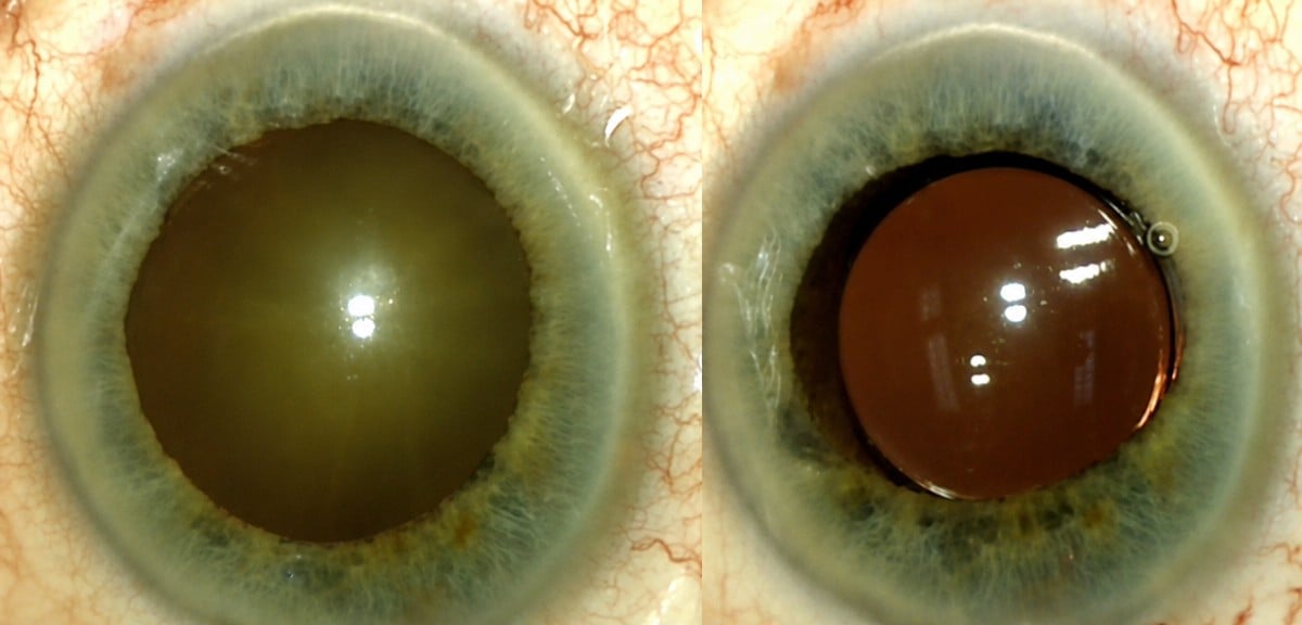 Resultados antes y después de cirugía de cataratas con LIO en clínica Dr Nikolaos I Dervenis