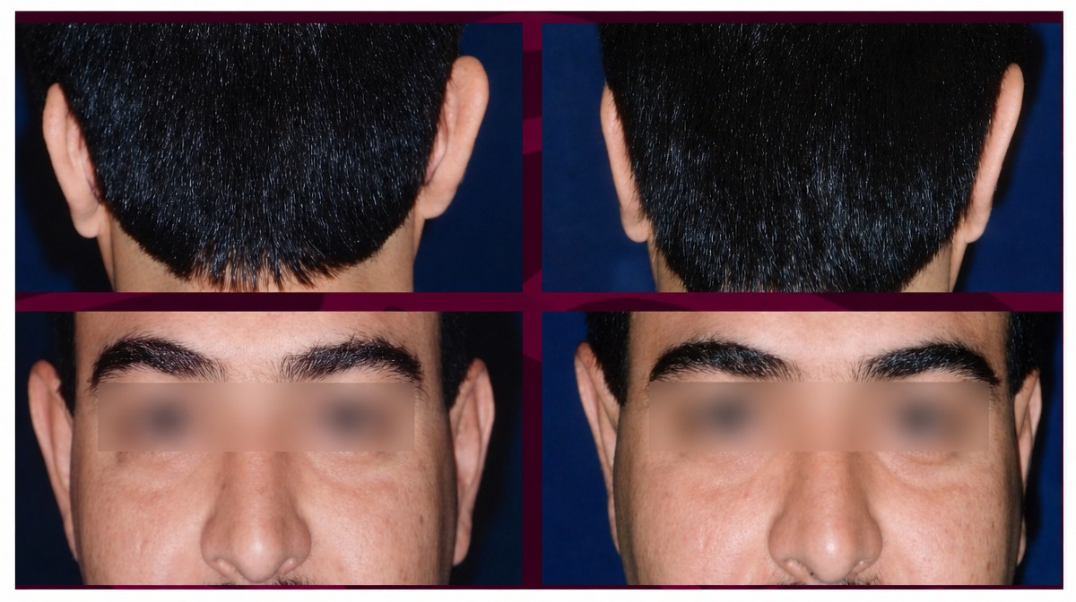 Resultados de otoplastia antes y después en Puebla Dermatologic and Cosmetic Surgery Clinic, corrección de orejas