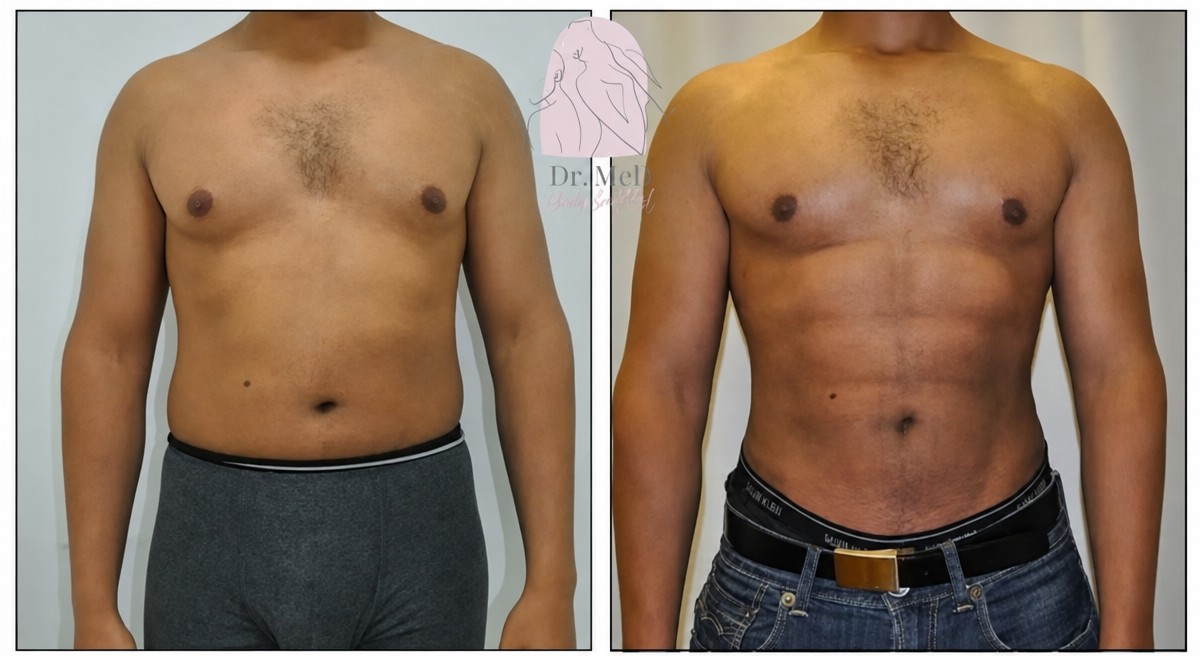 قبل وبعد نحت البطن في Dr. MED – إبراز عضلات البطن الستة بوضوح