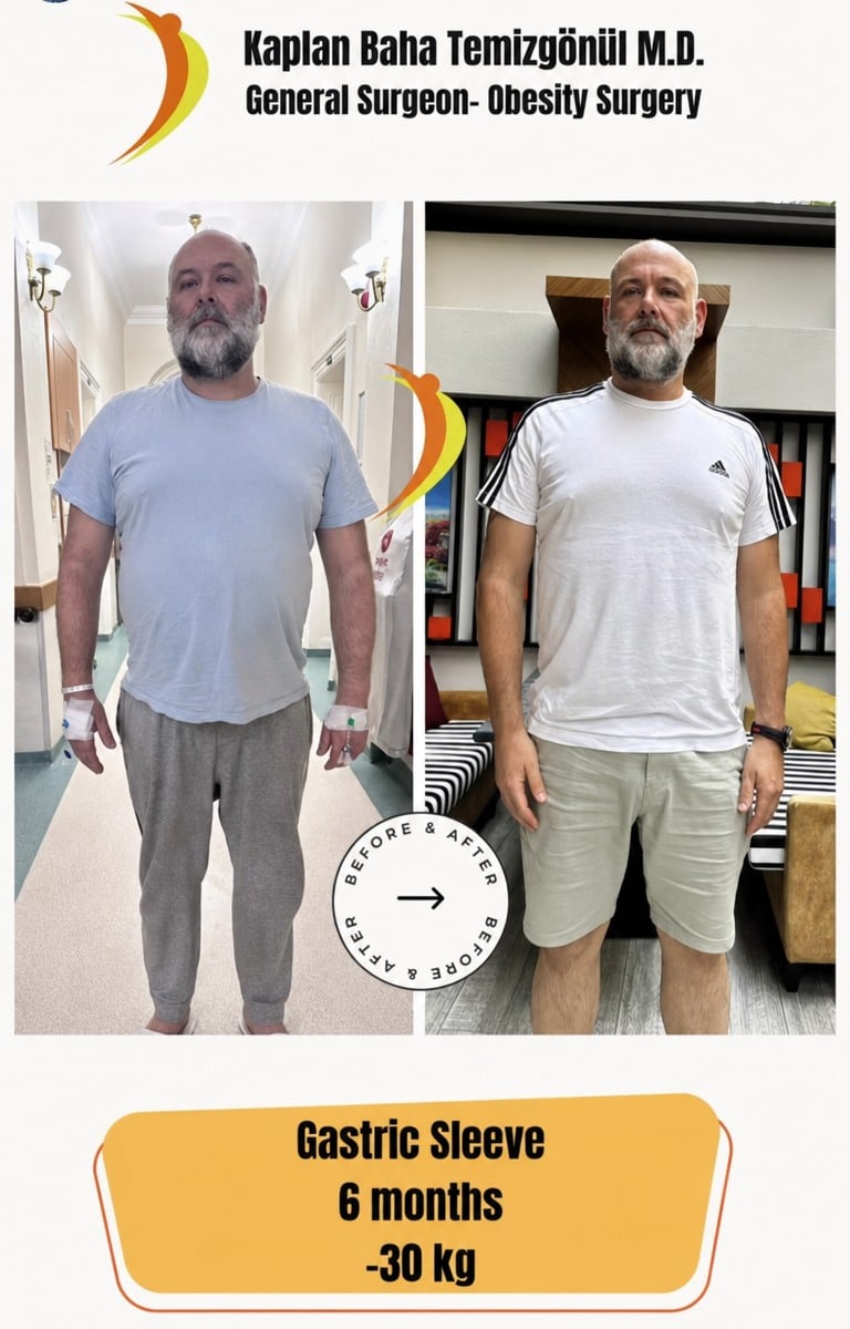 نتائج تكميم المعدة قبل وبعد في Lotus Bariatrics Clinic، فقدان 30 كجم خلال 6 أشهر