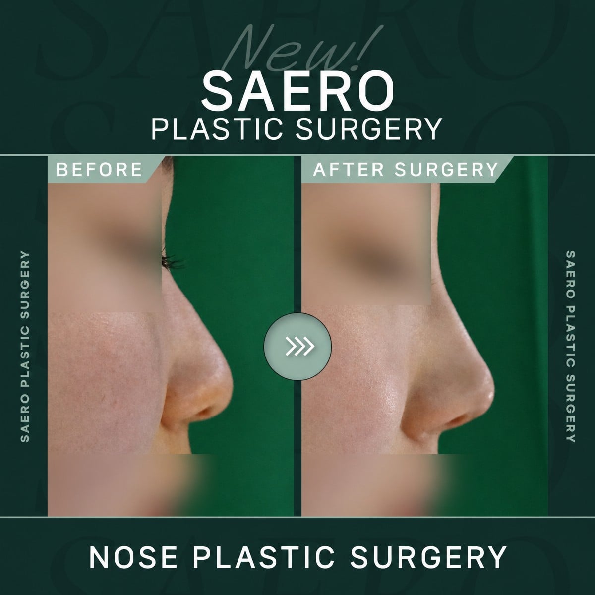 نتائج تجميل الأنف قبل وبعد في SAERO Plastic Surgery، تحسين شكل الأنف الجانبي