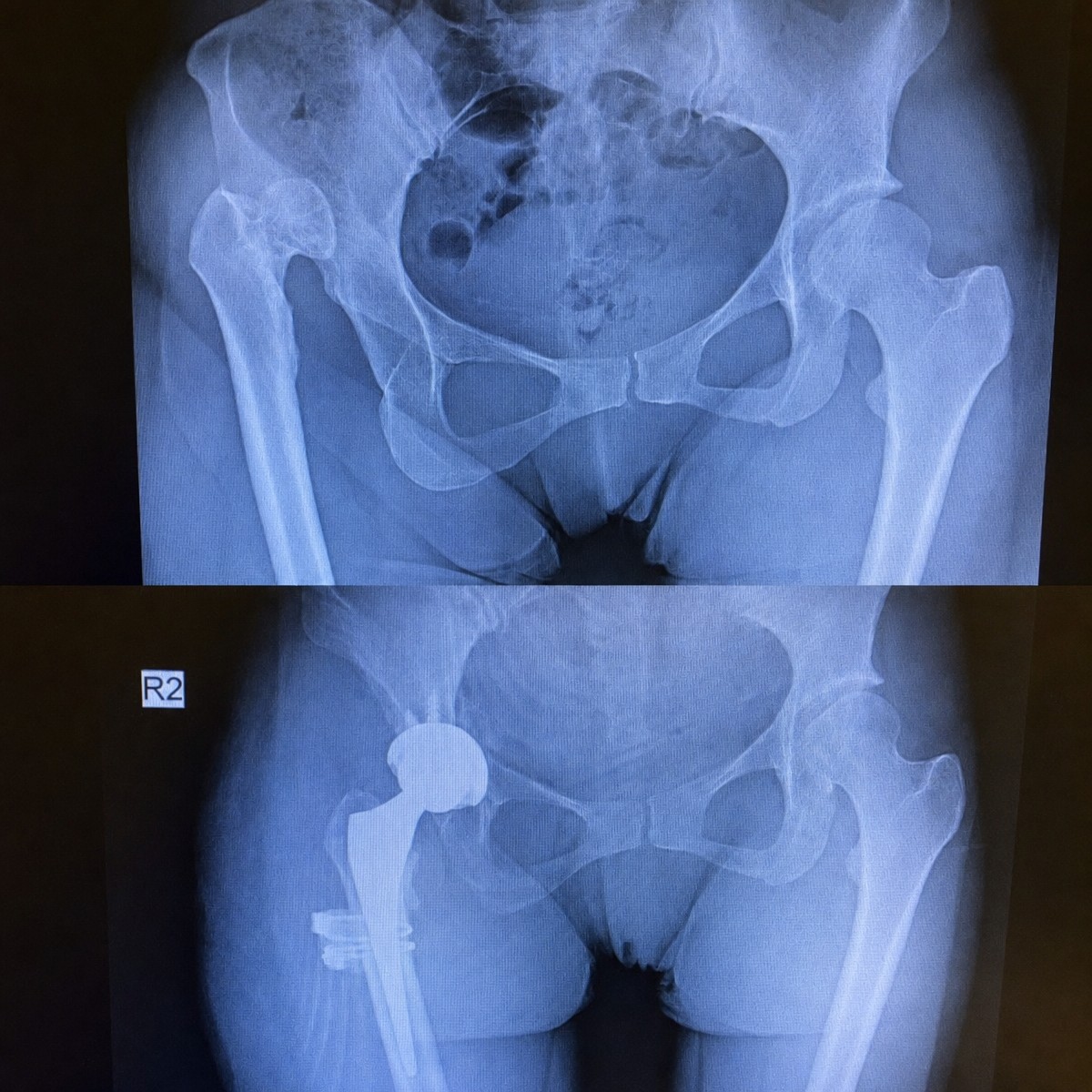 نتائج قبل وبعد استبدال مفصل الورك MAKOplasty في مستشفى Private Medicabil، تحسن المفصل