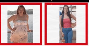 Vorher-nachher-Ergebnisse der Schlauchmagen-OP bei Ekol International Hospitals, sichtbarer Gewichtsverlust