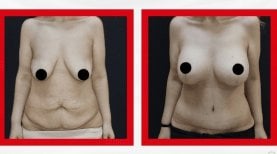 Resultados antes y después de mommy makeover en Ekol International Hospitals, mejor contorno corporal
