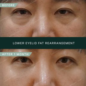 Vorher-nachher-Ergebnis der Unterlidfettverlagerung bei SAERO Plastic Surgery