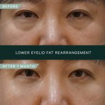 Vorher-nachher-Ergebnis der Unterlidfettverlagerung bei SAERO Plastic Surgery