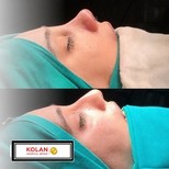 Resultados de rinoplastia antes y después en Kolan Hospital Group, perfil nasal mejorado